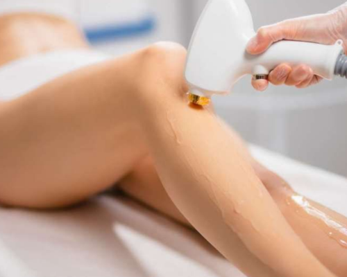 Leg Laser Hair Removal Mysore